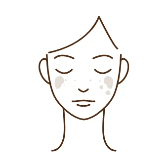 しみ(そばかす・ほくろ)