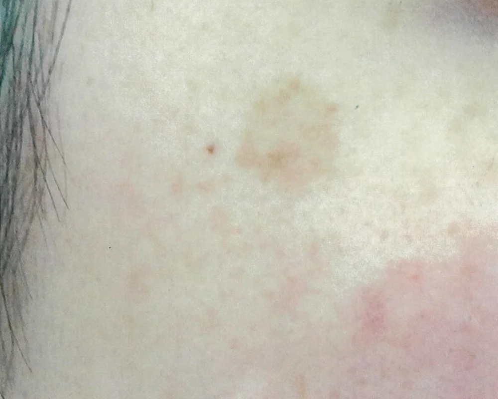 しみ取りレーザーBEFORE