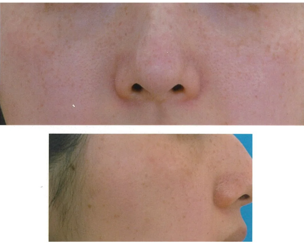 しみ取りレーザーAFTER