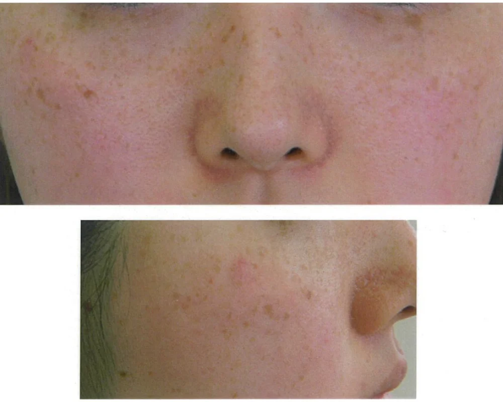 しみ取りレーザーBEFORE