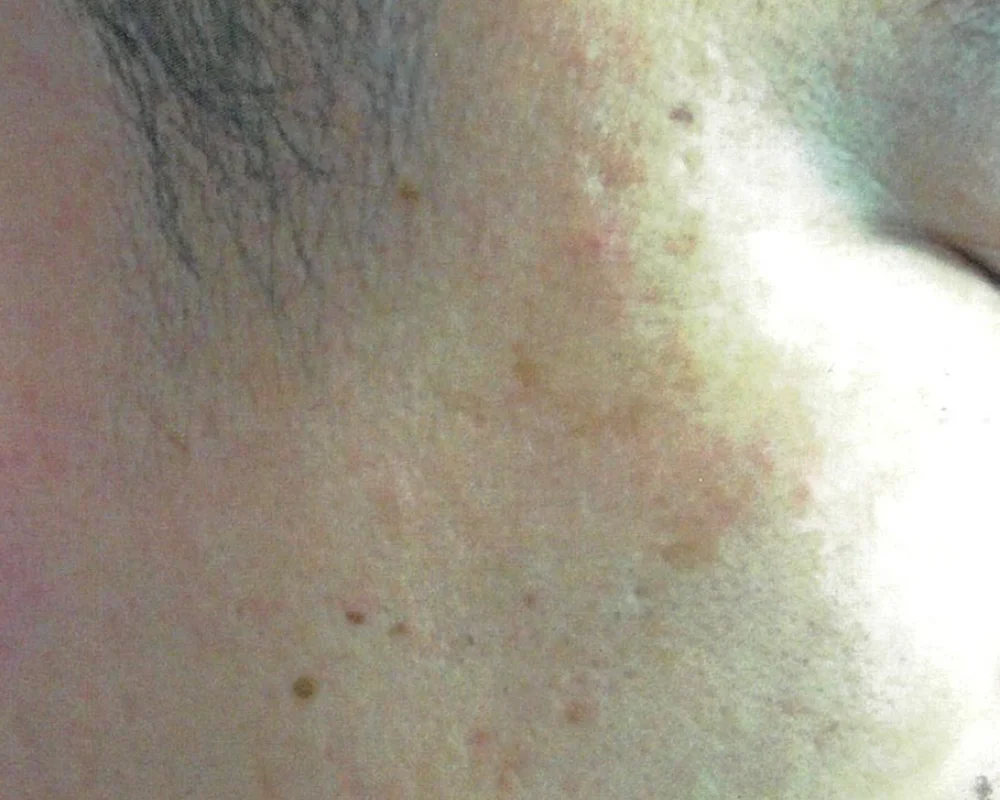 しみ取りレーザーAFTER